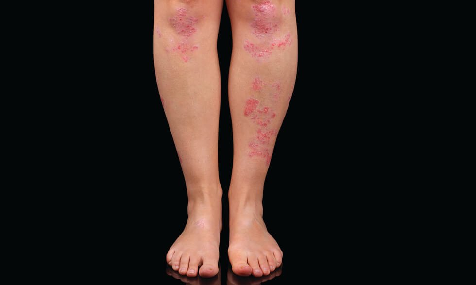 psoriasis